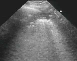Эхограмма грудной клетки больного Г. Продольное сканирование. Хронический абсцесс в стадии ложной кисты с толстыми стенками: 1 — гиперэхогенный сигнал от воздуха в полости абсцесса, 2 — пристеночная гиперэхогенная линия поверхности воздушного лёгкого, 3 — толстая гипоэхогенная стенка абсцесса