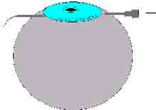 условной линии 3—9 ч, проведена игла 2-граммового одноразового шприца, в отверстие которой заранее была введена полипропиленовая нить 10-0