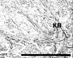 Аденокарцинома желудка —  гистологический срез фокуса опухоли, окраска по Ван-Гизону. КВ — коллагеновые волокна между комплексами опухоли