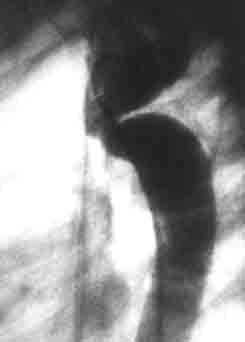 Фотоаортограмма больной К., 7 лет. Коарктация аорты, IIБ ангиографический тип — вторая косая стандартная проекция