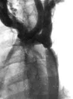 Фотоаортограмма больной Р., 5 лет. Коарктация аорты, III ангиографический тип — переднезадняя проекция