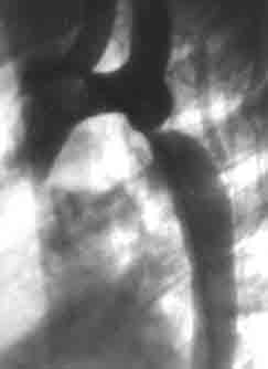 Фотоаортограмма больной Р., 5 лет. Коарктация аорты, III ангиографический тип — вторая косая стандартная проекция