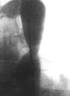 Фотоаортограмма больной Р., 12 лет. Коарктация аорты, IV ангиографический тип — переднезадняя проекция