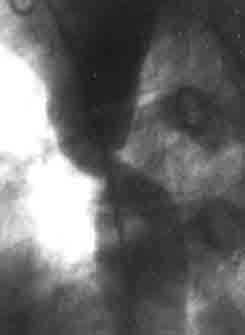 Фотоаортограмма больной Р., 12 лет. Коарктация аорты, IV ангиографический тип — вторая косая стандартная проекция 