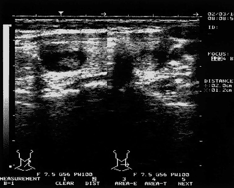 Эхограммы щитовидной железы  больной 36 лет с кистозным коллоидным узлов до лечения (объем кисты — 1,5 мл)